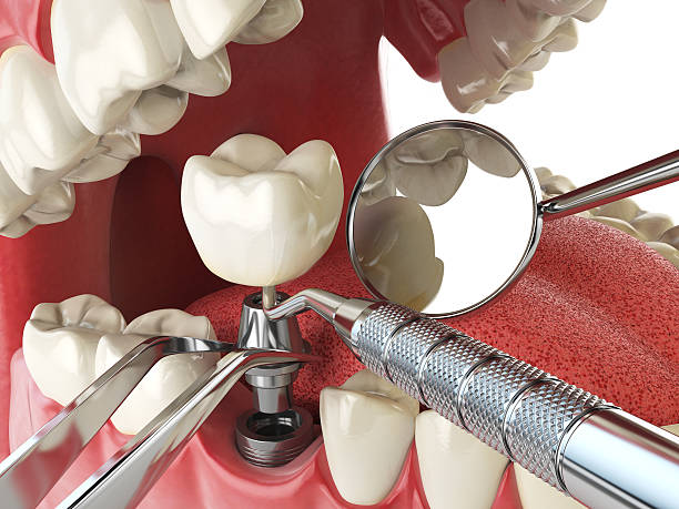Best Emergency Denture Repair in Napa, CA